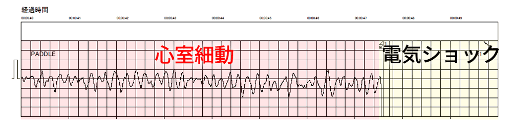 心室細動から電気ショック